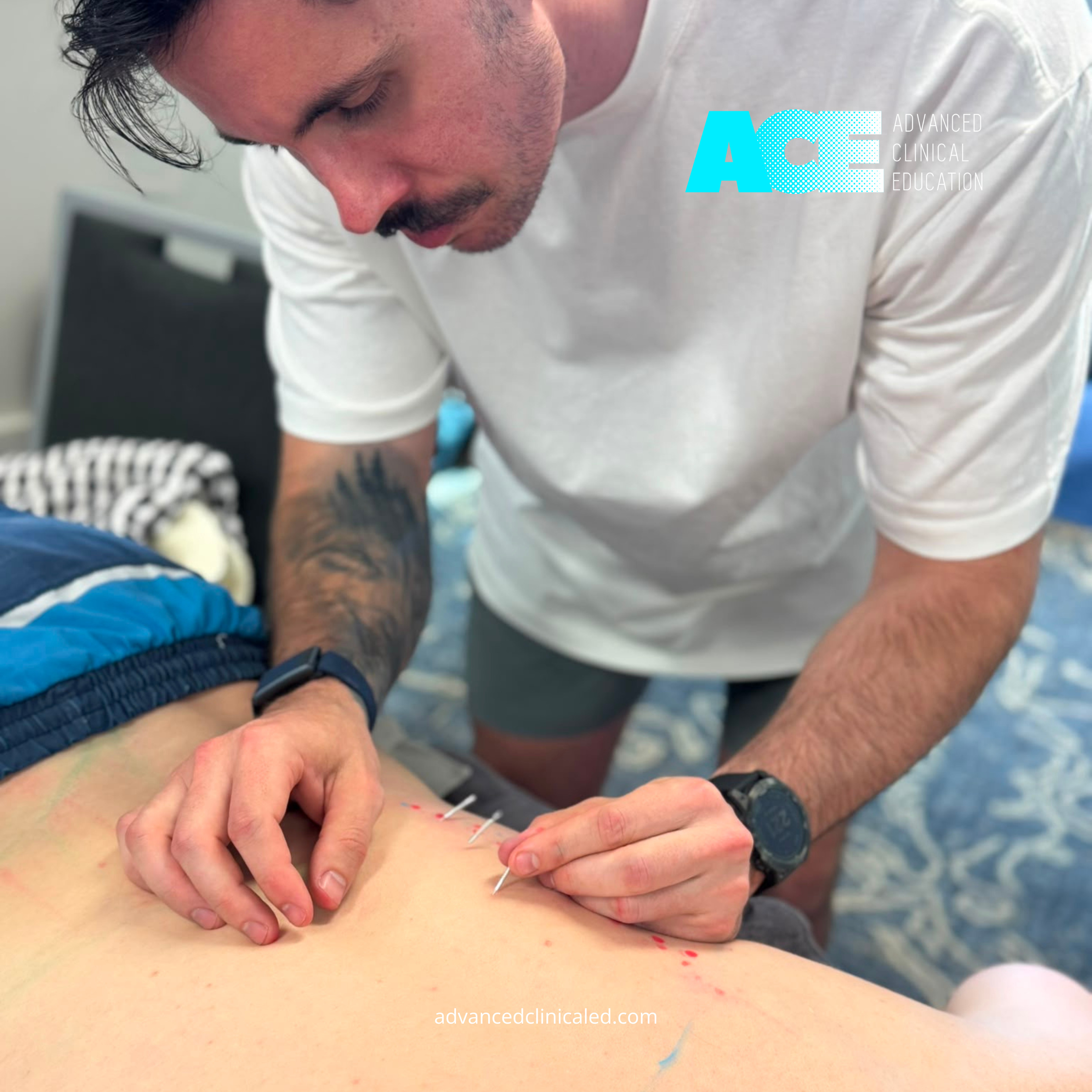 Dry Needling 2